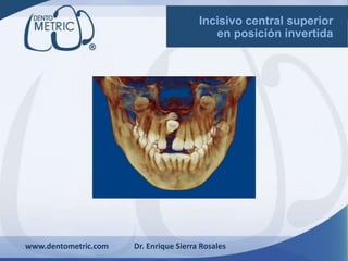 www.dentometric.com Dr. Enrique Sierra Rosales
Incisivo central superior
en posición invertida
 