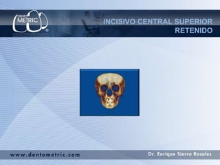 INCISIVO CENTRAL SUPERIOR
                 RETENIDO
 