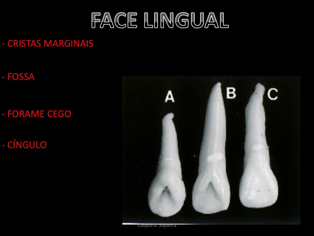 Incisivo Lateral Inferior Anatomia