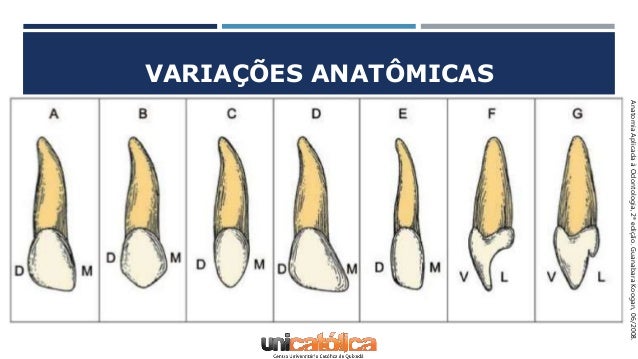 Incisivo Lateral Superior Anatomia Dental
