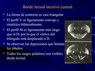 Borde incisal incisivo central La forma de contorno es casi triangular El perfil V es ligeramente convejo y simétrico bilateralmente. El perfil M es ligeramente más largo que el D, por lo que el vértice del triángulo está desplazado a D. Se observan las depresiones que limitan los lóbulos. Todos los rasgos palatinos son visibles desde incisal. 