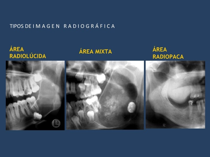 Incisivos superiores