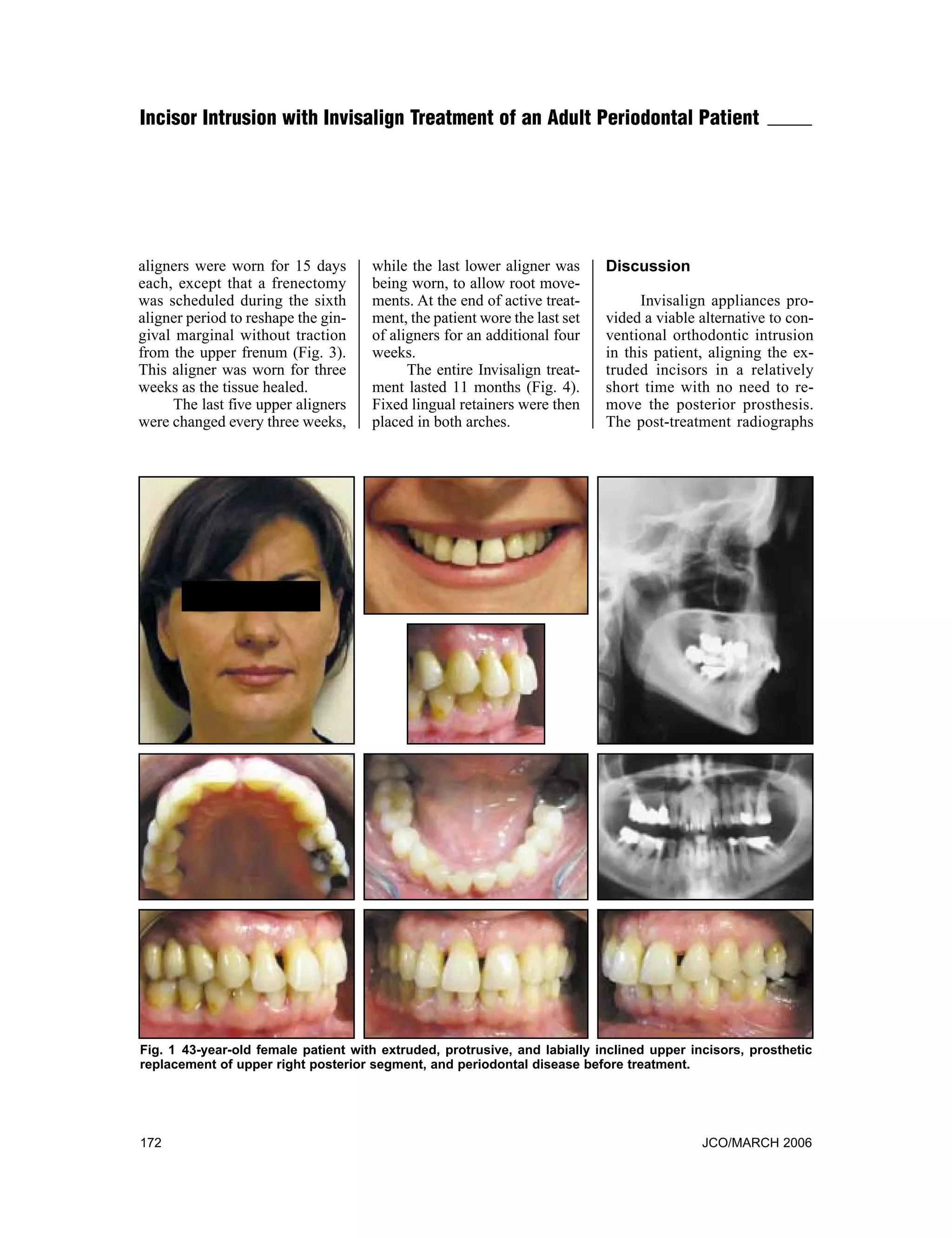 Incisor intrusion with invisalign treatment | PDF