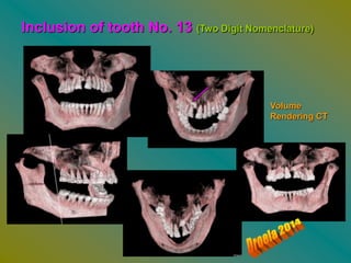 Inclusion of tooth No. 13 (Two Digit Nomenclature)

Volume
Rendering CT

 