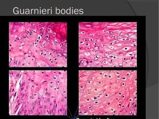 Guarnieri bodies
 