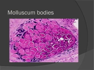 Molluscum bodies
 