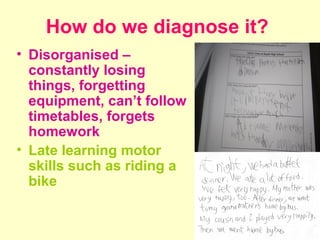 How do we diagnose it?
• Disorganised –
  constantly losing
  things, forgetting
  equipment, can’t follow
  timetables, forgets
  homework
• Late learning motor
  skills such as riding a
  bike
 