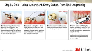 11
3M Marketing
All Rights Reserved.© 3M 2014
Step by Step – Labial Attachment, Safety Button, Push Rod Lengthening
 