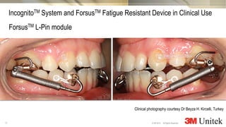 17
3M Marketing
All Rights Reserved.© 3M 2014
ForsusTM L-Pin module
IncognitoTM System and ForsusTM Fatigue Resistant Device in Clinical Use
Clinical photography courtesy Dr Beyza H. Kircelli, Turkey
 