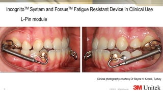 18
3M Marketing
All Rights Reserved.© 3M 2014
L-Pin module
IncognitoTM System and ForsusTM Fatigue Resistant Device in Clinical Use
Clinical photography courtesy Dr Beyza H. Kircelli, Turkey
 