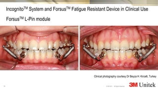 19
3M Marketing
All Rights Reserved.© 3M 2014
IncognitoTM System and ForsusTM Fatigue Resistant Device in Clinical Use
ForsusTM L-Pin module
Clinical photography courtesy Dr Beyza H. Kircelli, Turkey
 