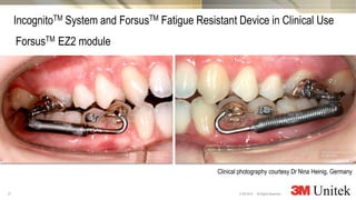 21
3M Marketing
All Rights Reserved.© 3M 2014
IncognitoTM System and ForsusTM Fatigue Resistant Device in Clinical Use
ForsusTM EZ2 module
Clinical photography courtesy Dr Nina Heinig, Germany
 