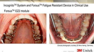 22
3M Marketing
All Rights Reserved.© 3M 2014
IncognitoTM System and ForsusTM Fatigue Resistant Device in Clinical Use
ForsusTM EZ2 module
Clinical photography courtesy Dr Nina Heinig, Germany
 