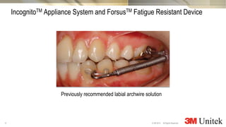 4
3M Marketing
All Rights Reserved.© 3M 2014
IncognitoTM Appliance System and ForsusTM Fatigue Resistant Device
Previously recommended labial archwire solution
 