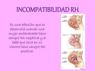 INCOMPATIBILIDAD RH
Es una afección que se
desarrolla cuando una
mujer embarazada tiene
sangre Rh negativa y el
bebé que lleva en su
vientre tiene sangre Rh
positiva.
 
