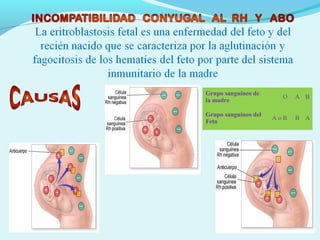 Grupo sanguíneo de
la madre
O A B
Grupo sanguíneo del
Feto
A o B B A
 