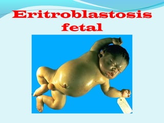 Eritroblastosis
fetal
 
