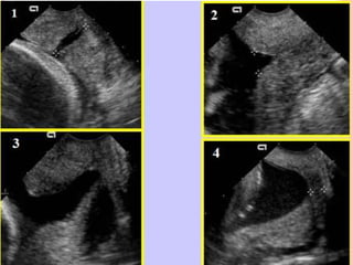 INCOMPETENCIA ITSMICO CERVICAL