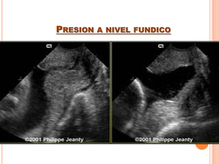 INCOMPETENCIA ITSMICO CERVICAL
