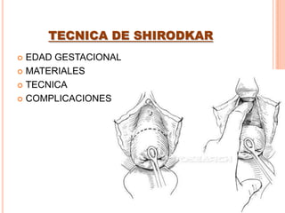 INCOMPETENCIA ITSMICO CERVICAL