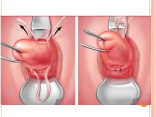 INCOMPETENCIA ITSMICO CERVICAL