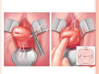 INCOMPETENCIA ITSMICO CERVICAL