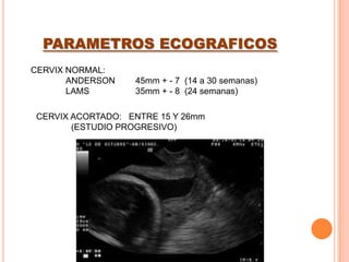 INCOMPETENCIA ITSMICO CERVICAL