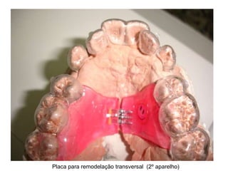 Placa para remodelação transversal  (2º aparelho)