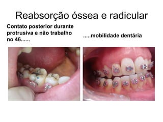 Reabsorção óssea e radicularContato posterior durante protrusiva e não trabalho no 46...........mobilidade dentária 