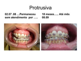 Protrusiva 02.07 .08 …Permaneceu sem atendimento  por …..18 meses….. Até mês  08.09