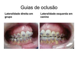 Guias de oclusãoLateralidade direita em grupoLateralidade esquerda em canino