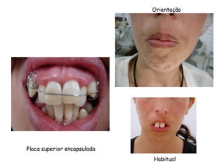 OrientaçãoPlaca superior encapsuladaHabitual