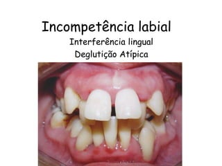 Incompetência labial Interferência lingual Deglutição Atípica 
