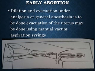 EARLY ABORTION
• Dilation and evacuation under
analgesia or general anesthesia is to
be done evacuation of the uterus may
be done using manual vacum
aspiration syringe
 