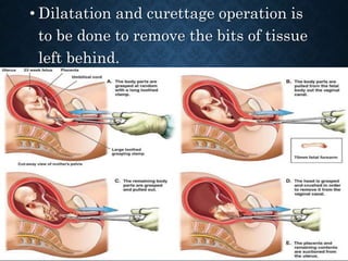 • Dilatation and curettage operation is
to be done to remove the bits of tissue
left behind.
 