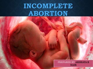 INCOMPLETE
ABORTION
PREPARED BY AKSHAYA R
NAIR
 