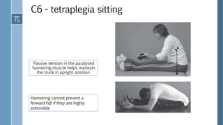 C6 - tetraplegia sitting
Passive tension in the paralysed
hamstring muscle helps maintain
the trunk in upright position
Hamstring cannot prevent a
forward fall if they are highly
extensible
 