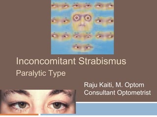 Inconcomitant Strabismus
Paralytic Type
Raju Kaiti, M. Optom
Consultant Optometrist
 