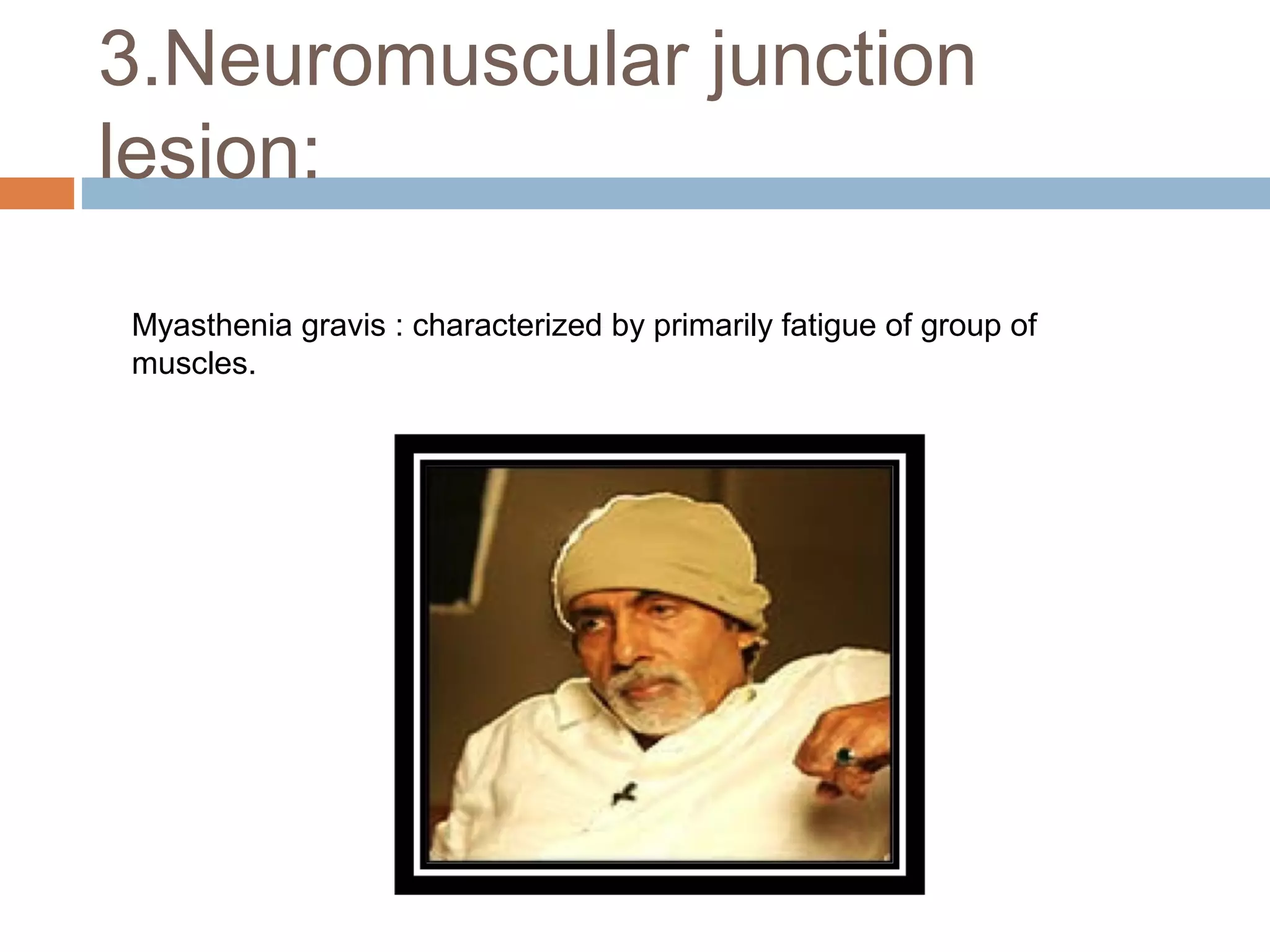 3.Neuromuscular junction
lesion:
Myasthenia gravis : characterized by primarily fatigue of group of
muscles.
 