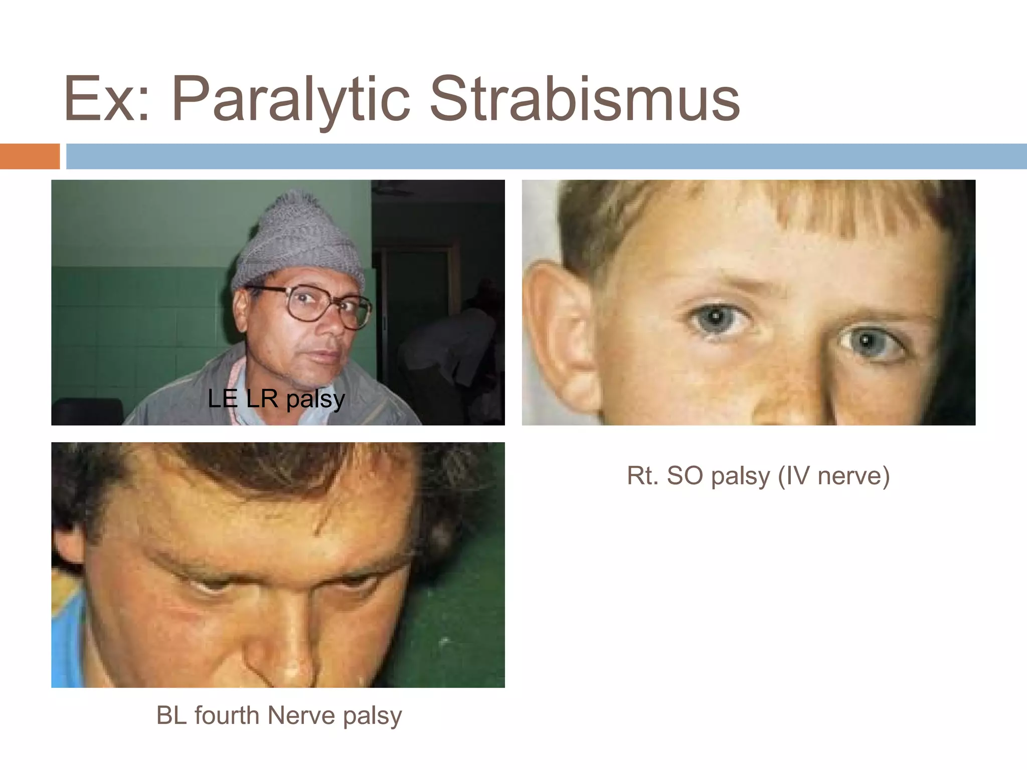 Ex: Paralytic Strabismus
LE LR palsy
Rt. SO palsy (IV nerve)
BL fourth Nerve palsy
 
