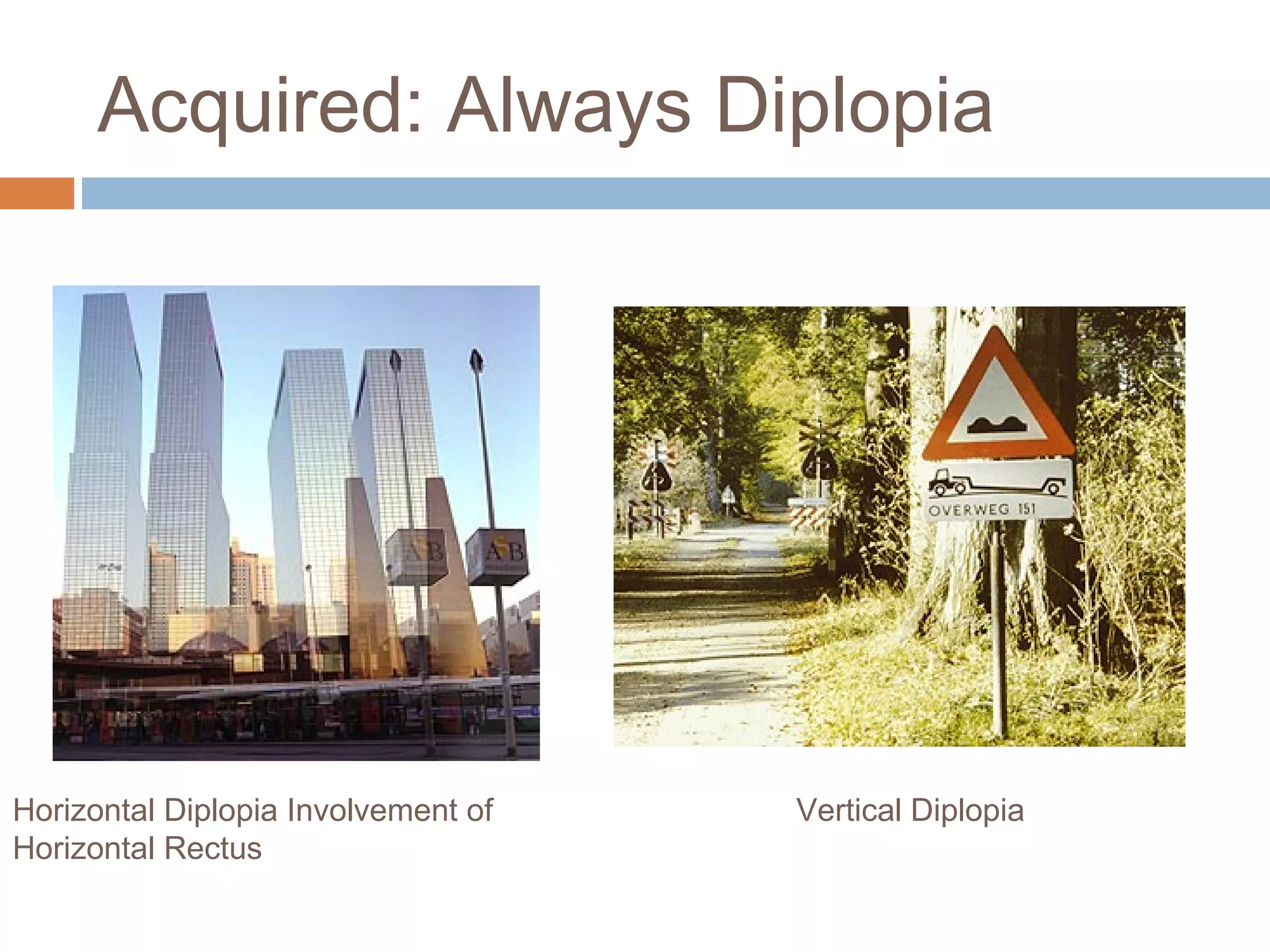 Acquired: Always Diplopia
Horizontal Diplopia Involvement of
Horizontal Rectus
Vertical Diplopia
 