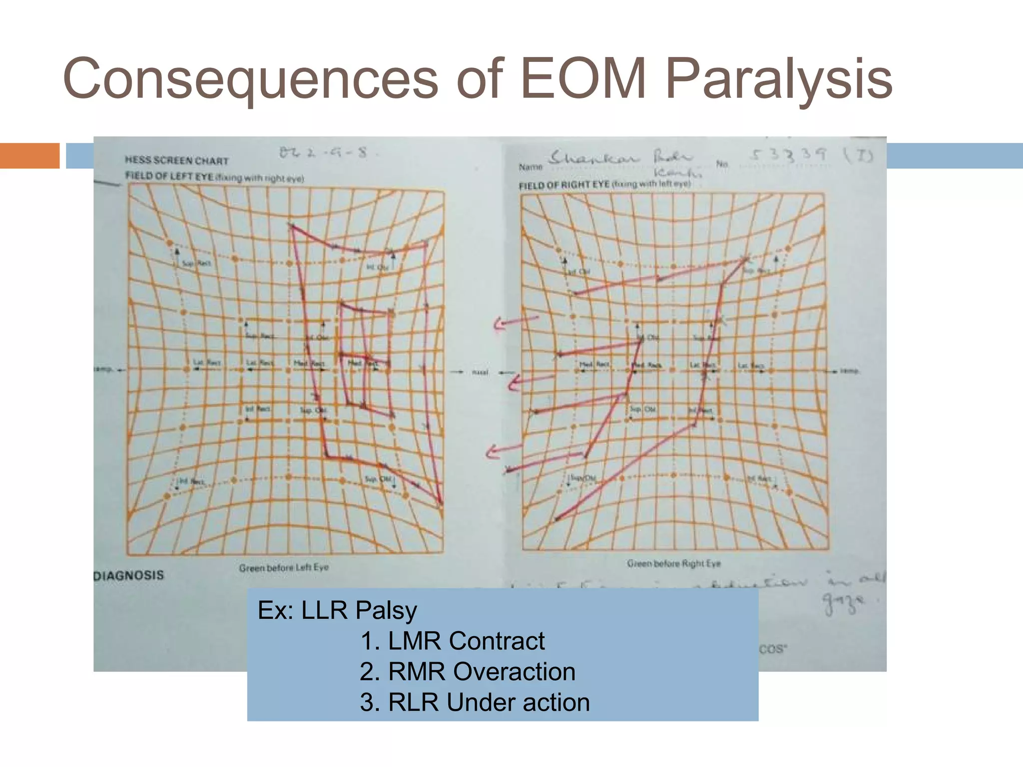 Consequences of EOM Paralysis
Ex: LLR Palsy
1. LMR Contract
2. RMR Overaction
3. RLR Under action
 