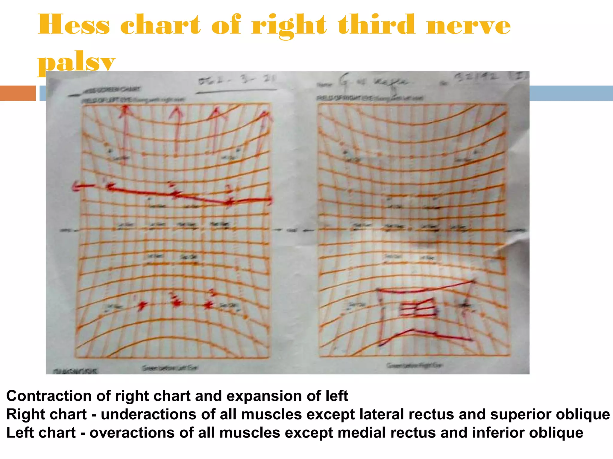 Hess chart of right third nerve
palsy
Contraction of right chart and expansion of left
Right chart - underactions of all muscles except lateral rectus and superior oblique
Left chart - overactions of all muscles except medial rectus and inferior oblique
 