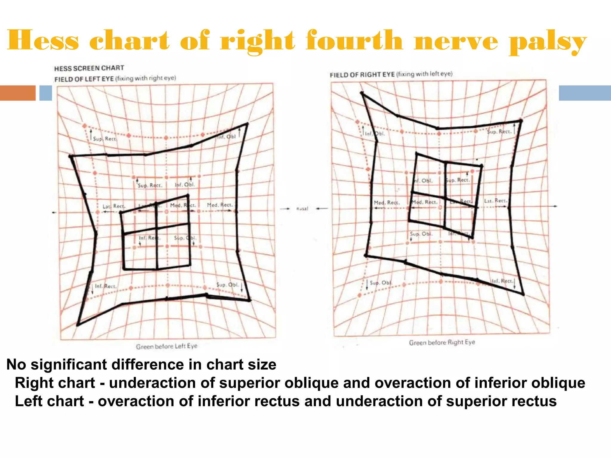 Hess chart of right fourth nerve palsy
No significant difference in chart size
Right chart - underaction of superior oblique and overaction of inferior oblique
Left chart - overaction of inferior rectus and underaction of superior rectus
 