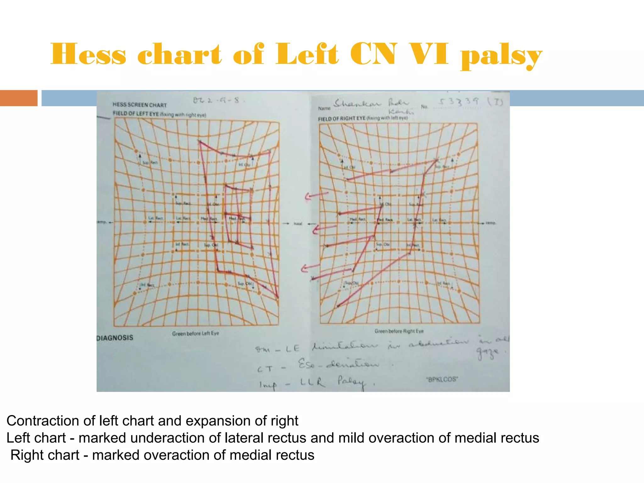 Hess chart of Left CN VI palsy
Contraction of left chart and expansion of right
Left chart - marked underaction of lateral rectus and mild overaction of medial rectus
Right chart - marked overaction of medial rectus
 