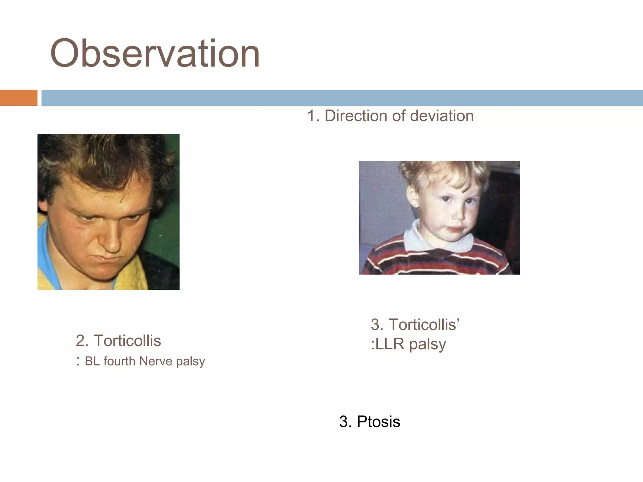 Observation
2. Torticollis
: BL fourth Nerve palsy
3. Torticollis’
:LLR palsy
1. Direction of deviation
3. Ptosis
 