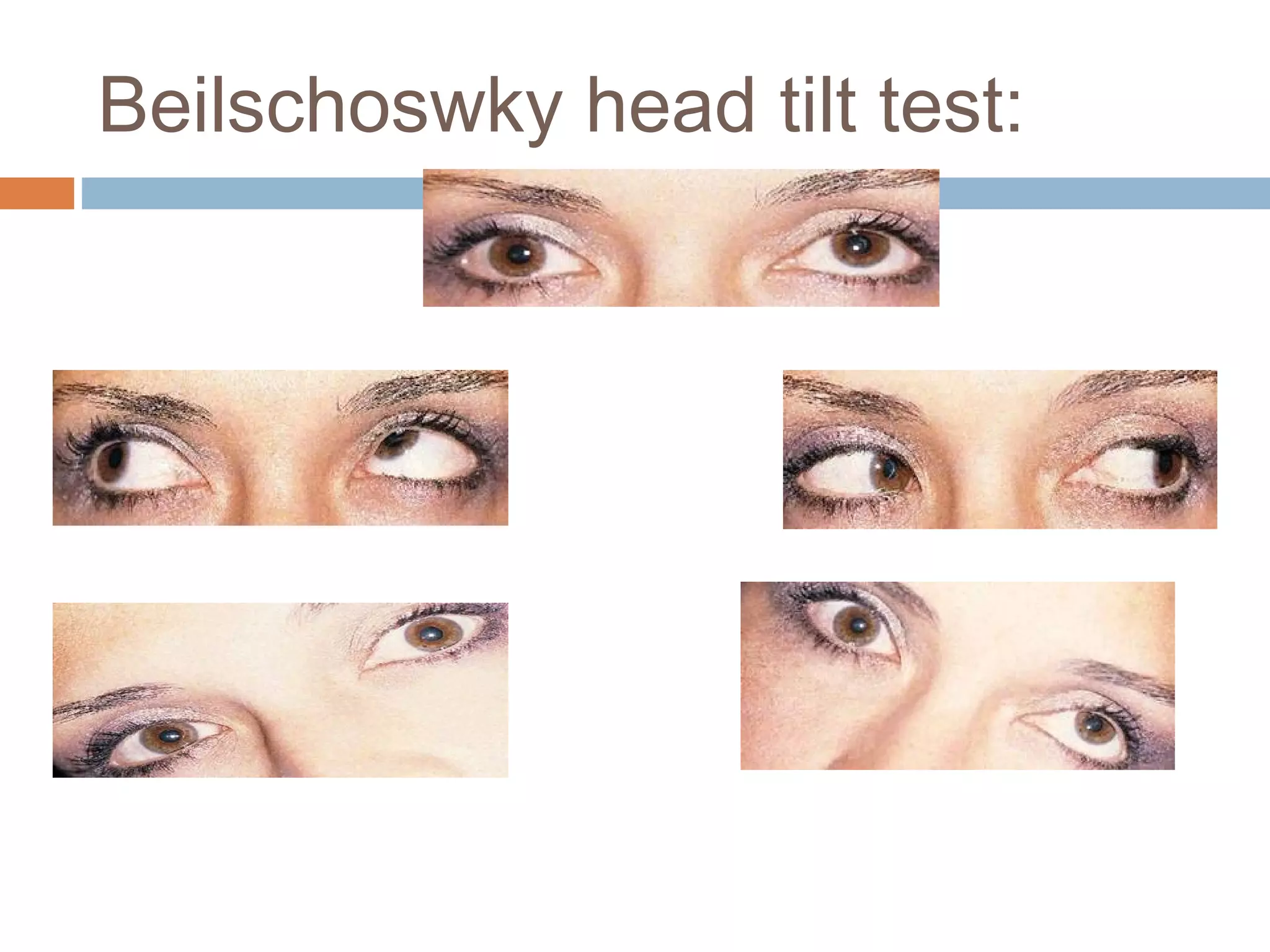 Beilschoswky head tilt test:
 