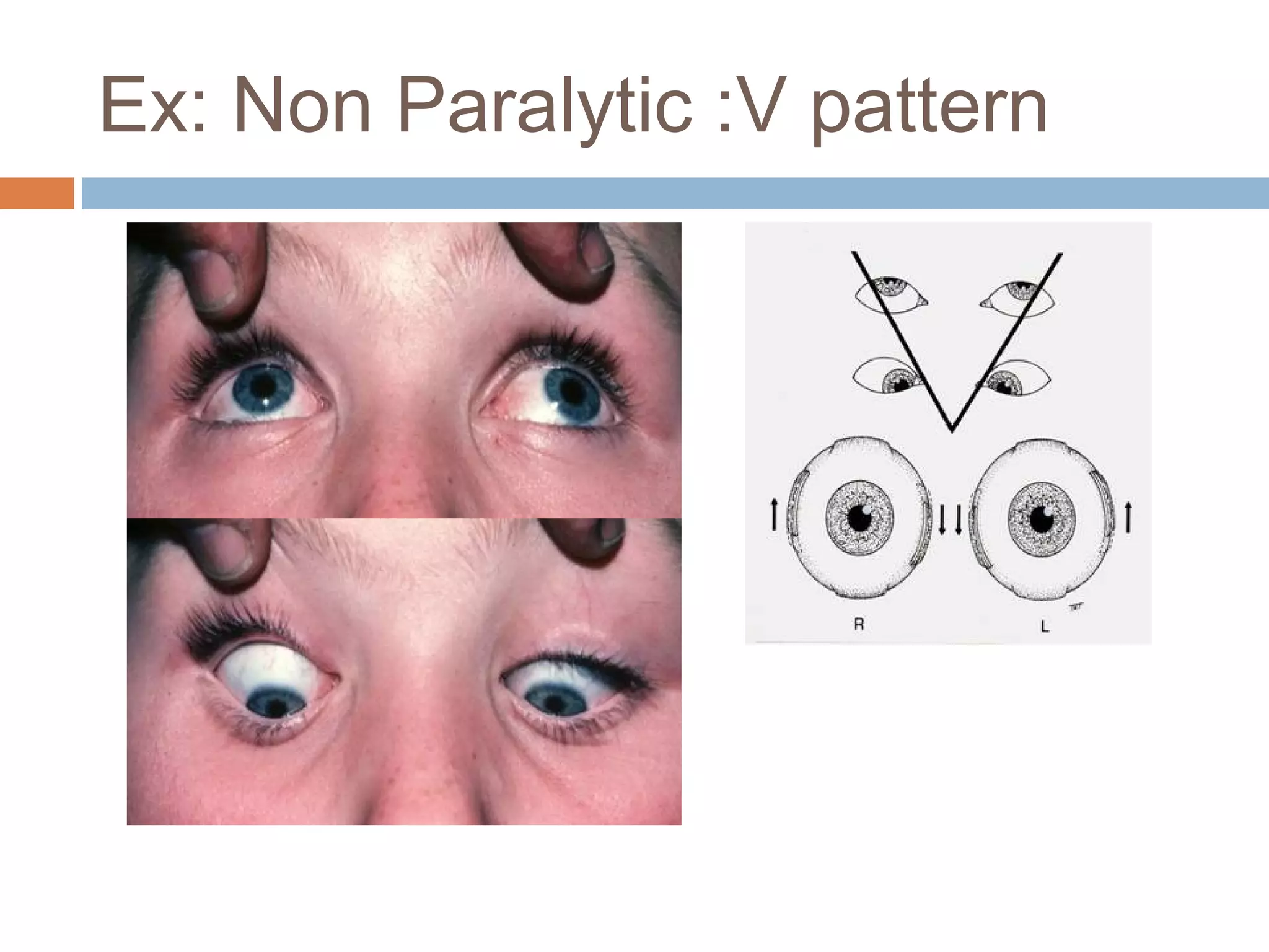 Ex: Non Paralytic :V pattern
 