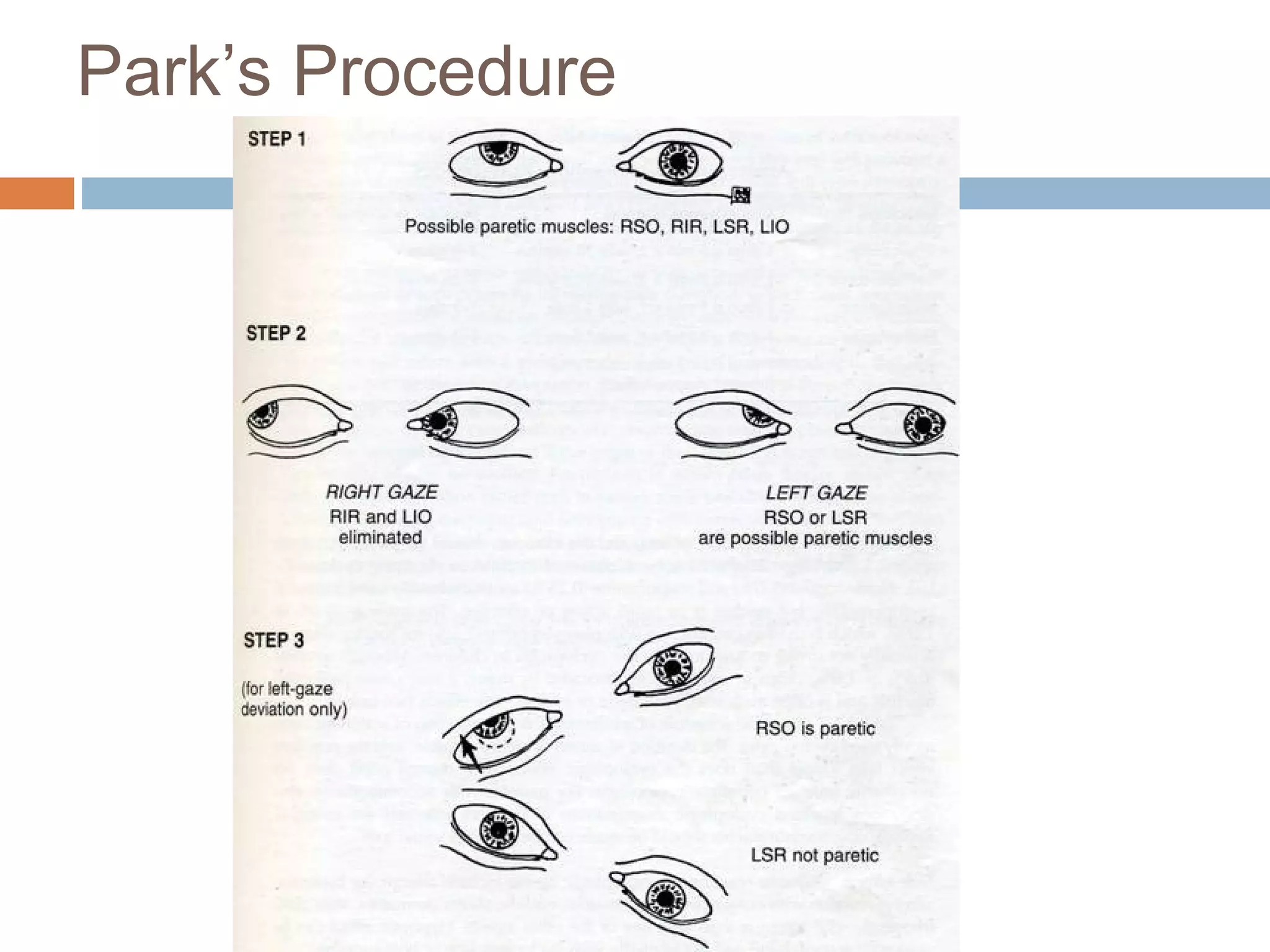 Park’s Procedure
 