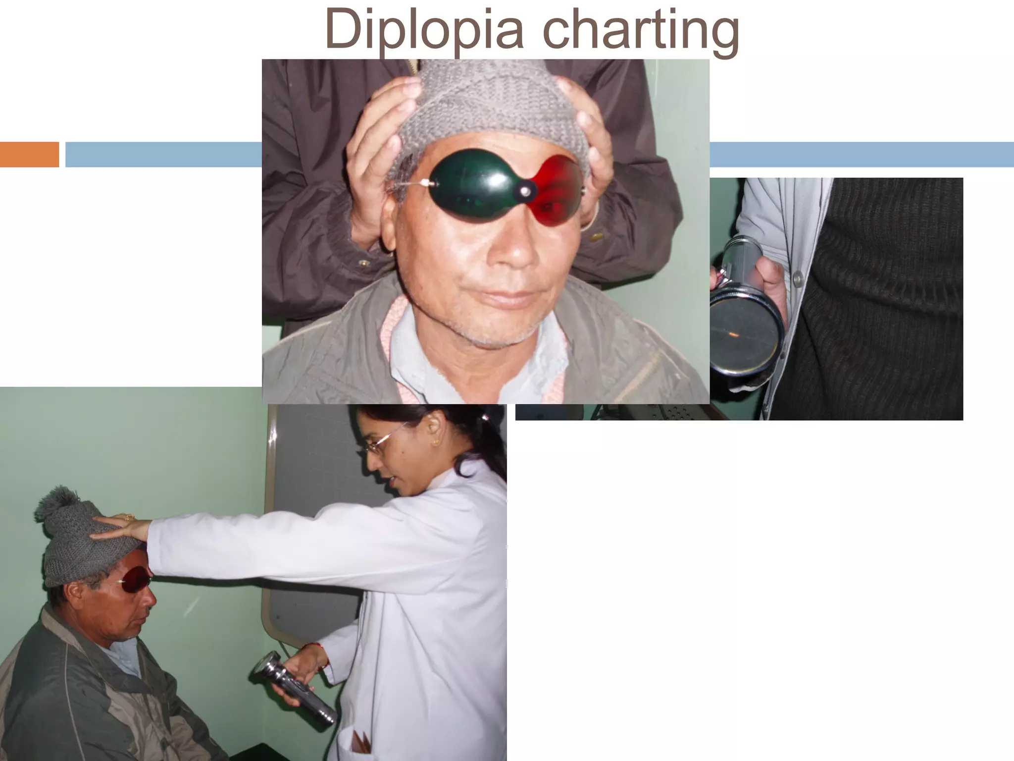 Diplopia charting
 